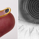 Illustration for article titled An Eyeball Implant That Fixes a Very Common Ailment